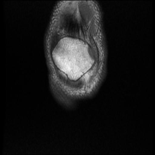 File:Bucket handle tear - medial meniscus (Radiopaedia 69245-79026 Coronal T1 1).jpg