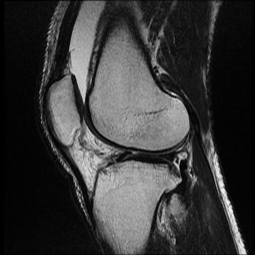 File:Bucket handle tear - medial meniscus (Radiopaedia 69245-79026 Sagittal T2 2).jpg