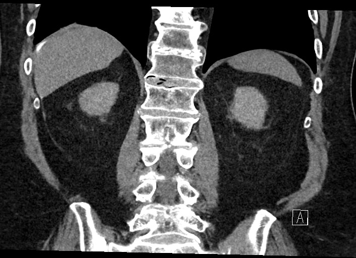 File:Buried bumper syndrome - gastrostomy tube (Radiopaedia 63843-72577 Coronal Inject 100).jpg