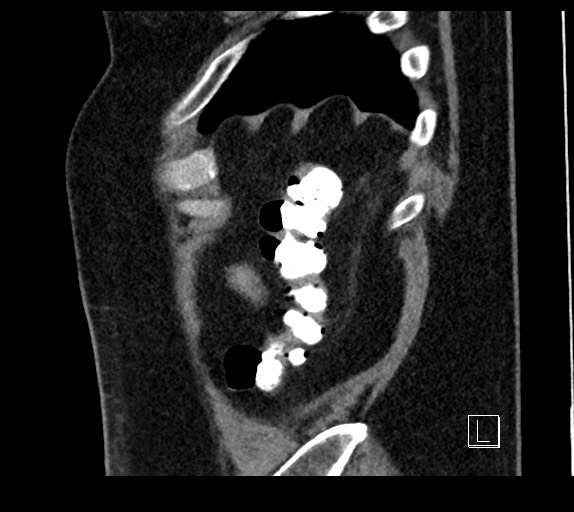Buried bumper syndrome - gastrostomy tube (Radiopaedia 63843-72577 Sagittal Inject 12).jpg