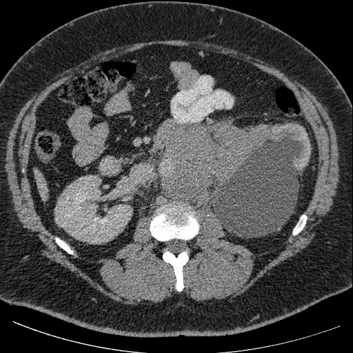 Burned-out testicular seminoma - retroperitoneal nodal metastases (Radiopaedia 62872-71245 A 32).jpg