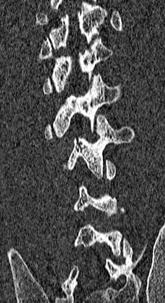 Burst fracture (Radiopaedia 53373-59357 Coronal bone window 61).jpg