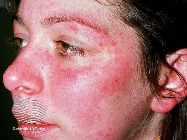 File:Butterfly rash (DermNet NZ immune-sle-05).jpg