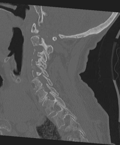C2 fracture with vertebral artery dissection (Radiopaedia 37378-39199 Sagittal bone window 48).png