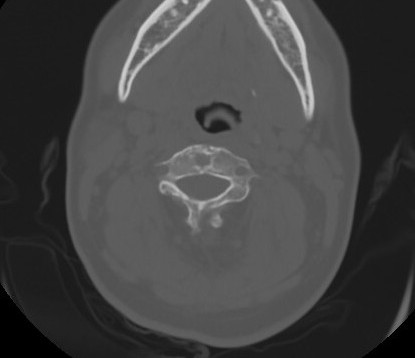 C7 laminar fracture and Klippel-Feil syndrome (Radiopaedia 86710-102850 Axial bone window 35).jpg