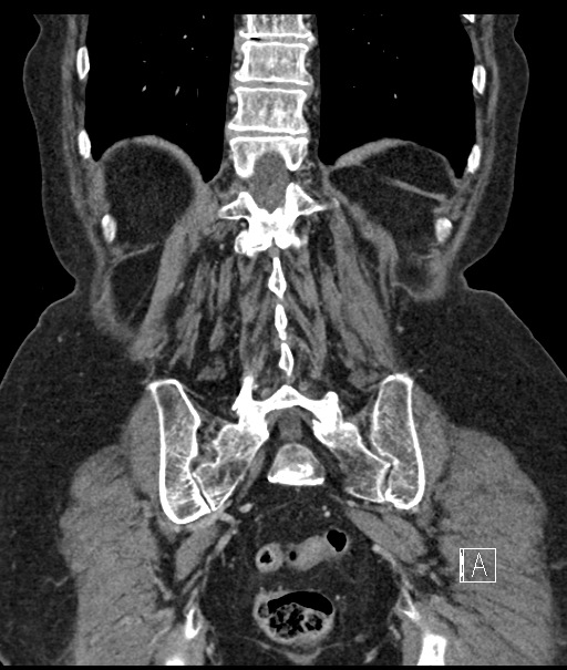 Calcified adrenal glands and Spigelian hernia (Radiopaedia 49741-54988 B 93).jpg