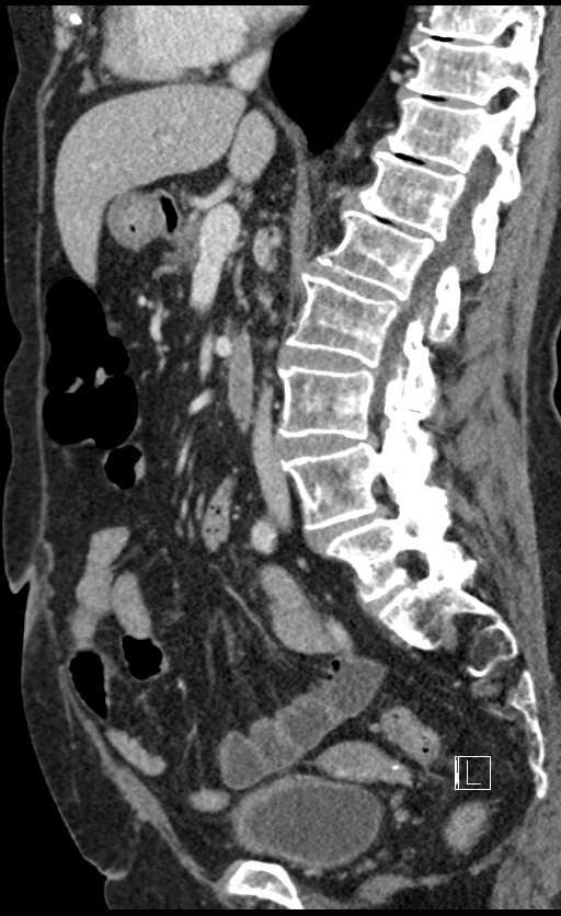 Calcified adrenal glands and Spigelian hernia (Radiopaedia 49741-54988 C 88).jpg