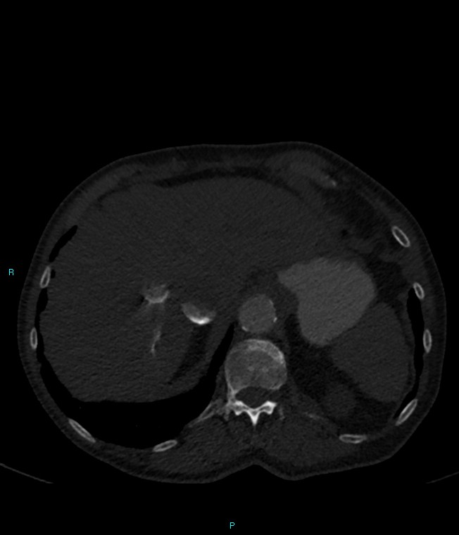 Calcified cerebral emboli from left ventricular thrombus (Radiopaedia 84420-99760 Axial bone window 77).jpg