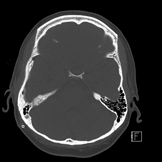 File:Calcified chronic subdural hematoma (Radiopaedia 77374-89492 Axial bone window 39).jpg