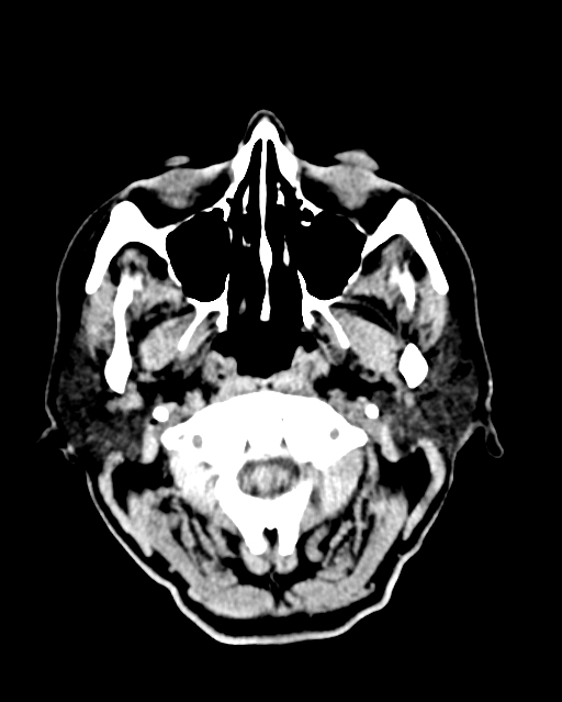 Calcified meningioma (Radiopaedia 74361-85243 Axial non-contrast 52).jpg