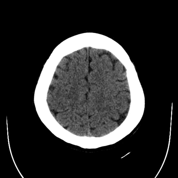 Calvarial osteoma (Radiopaedia 36520-38079 Axial non-contrast 46).jpg