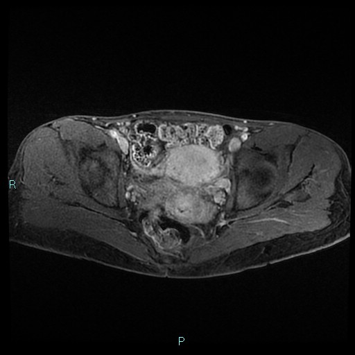 File:Canal of Nuck cyst (Radiopaedia 55074-61448 Axial T1 C+ fat sat 34).jpg