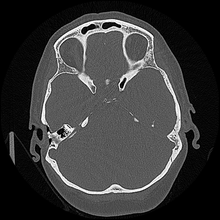 Canal up mastoidectomy (Radiopaedia 78108-90638 Axial bone window 107).jpg