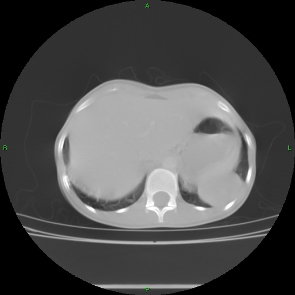File:Cannon ball metastases - synovial sarcoma (Radiopaedia 26135-26271 Axial lung window 34).jpg
