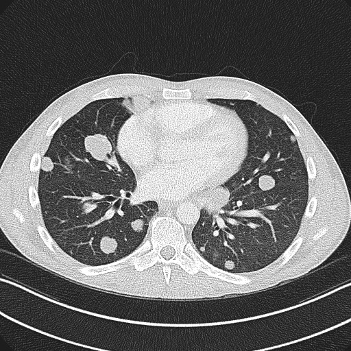 Cannonball metastases - testicular choriocarcinoma (Radiopaedia 84510-99891 Axial lung window 59).jpg