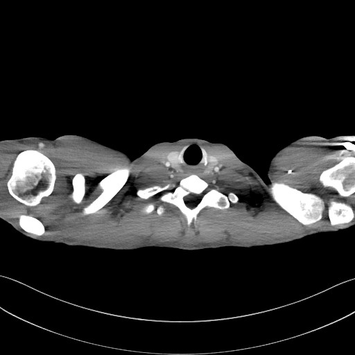 Cannonball metastases - testicular choriocarcinoma (Radiopaedia 84510-99891 B 11).jpg