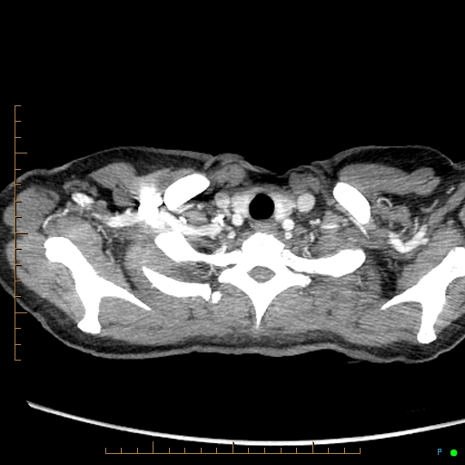 Canonball lung metastasis (Radiopaedia 77634-89837 B 2).jpg