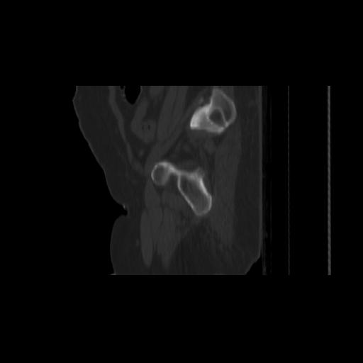 Carcinoma cervix- brachytherapy applicator (Radiopaedia 33135-34173 Sagittal bone window 153).jpg