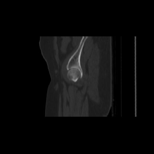 Carcinoma cervix- brachytherapy applicator (Radiopaedia 33135-34173 Sagittal bone window 2).jpg