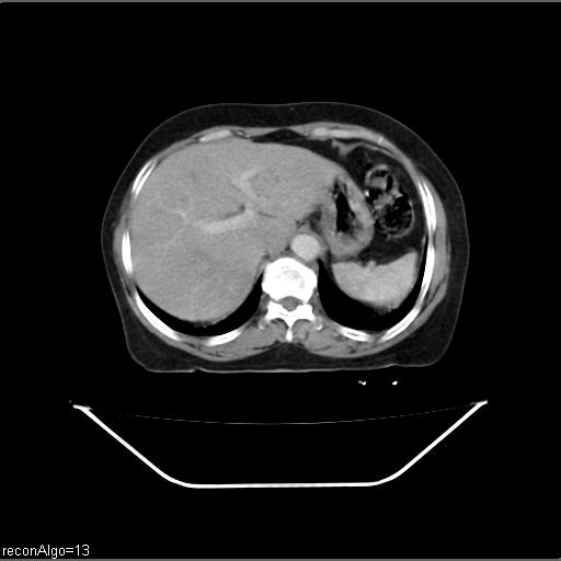 File:Carcinoma cervix- recurrence (Radiopaedia 34702-36137 B 11).jpg