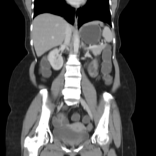 File:Carcinoma colon - hepatic flexure (Radiopaedia 19461-19493 B 23).jpg