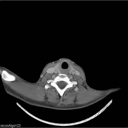 Carcinoma of the maxillary antrum (Radiopaedia 53805-59888 Axial C+ delayed 11).jpg
