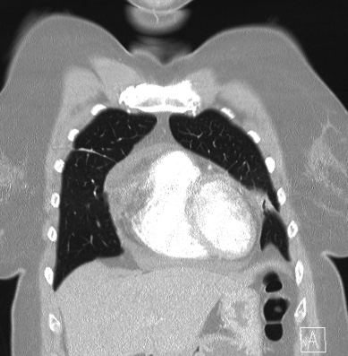 Cardiac sarcoidosis (Radiopaedia 74548-85534 Coronal lung window 13).jpg