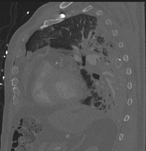 Cardiac trauma (Radiopaedia 32874-33858 Sagittal bone window 3).jpg