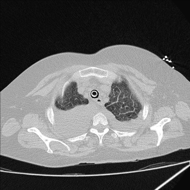 Cardiogenic pulmonary edema (Radiopaedia 29213-29609 Axial lung window 11).jpg