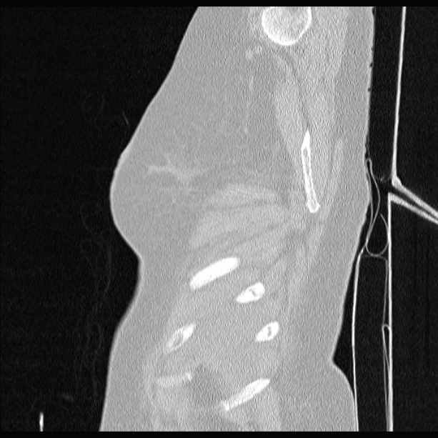 Cardiogenic pulmonary edema (Radiopaedia 29213-29609 Sagittal lung window 6).jpg