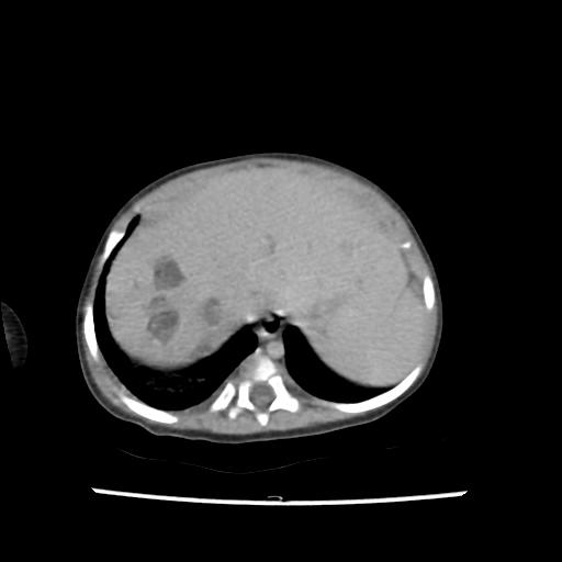 File:Caroli disease with autosomal recessive polycystic kidney disease (ARPKD) (Radiopaedia 89651-106703 B 25).jpg