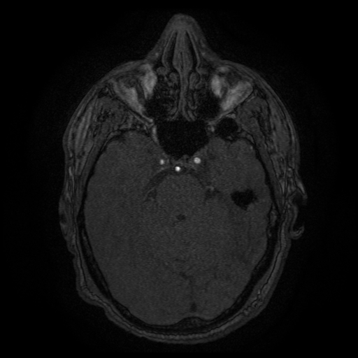 Carotid arterial dissection with acute cerebral infarction (Radiopaedia 26636-26784 MRA 117).jpg