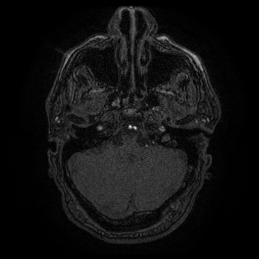 Carotid arterial dissection with acute cerebral infarction (Radiopaedia 26636-26784 MRA 141).jpg