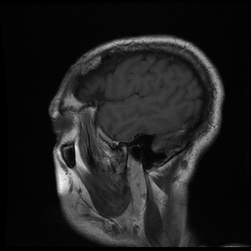 File:Carotid arterial dissection with acute cerebral infarction (Radiopaedia 26636-26784 Sagittal T1 C+ 2).jpg
