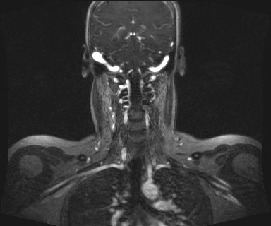 Carotid body tumor (Radiopaedia 12777-12912 MRA 45).jpg