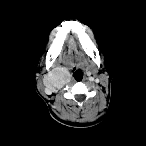 File:Carotid body tumor (Radiopaedia 27890-28124 A 15).jpg