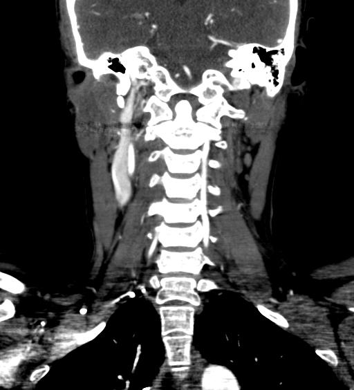 File:Carotid body tumor (Radiopaedia 39845-42300 C 63).jpg