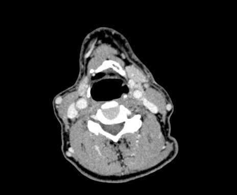 File:Carotid body tumor (Radiopaedia 61750-69757 Axial Post contrast 59).jpg