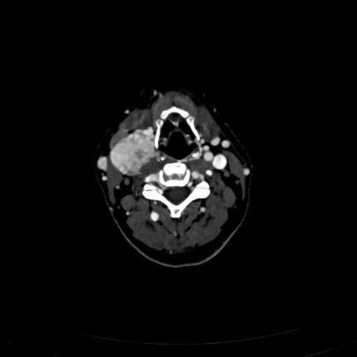 Carotid body tumor (Radiopaedia 83615-98727 D 62).jpg