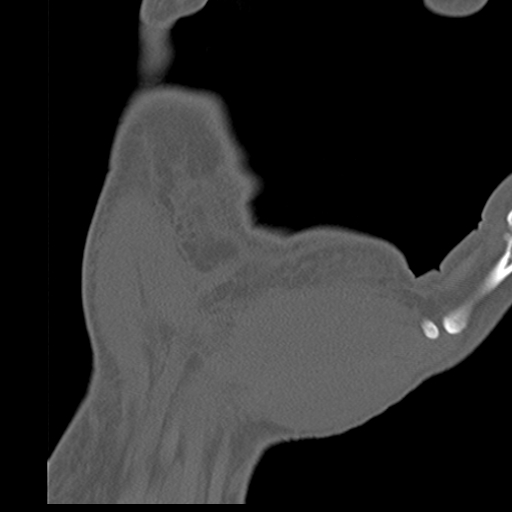 File:Carpo-metacarpal fracture-dislocations with hamatum split fracture (Radiopaedia 18482-18343 Coronal bone window 20).jpg