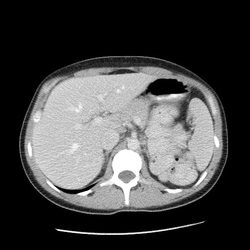 Castleman disease with fibrous pseudotumor in the abdomen (Radiopaedia 77296-89373 A 33).jpg