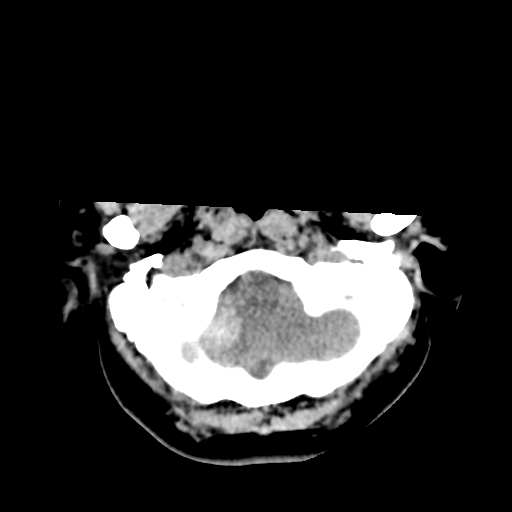 Cavernoma with hemorrhage (Radiopaedia 70755-80931 Axial non-contrast 8).png