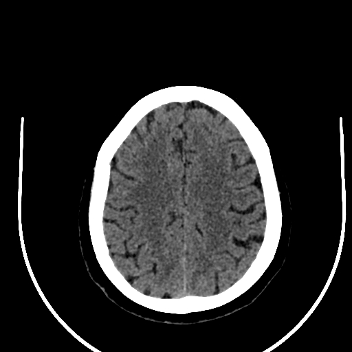 Cavernous hemangioma of the cerebellar falx (Radiopaedia 73025-83723 Axial non-contrast 102).jpg