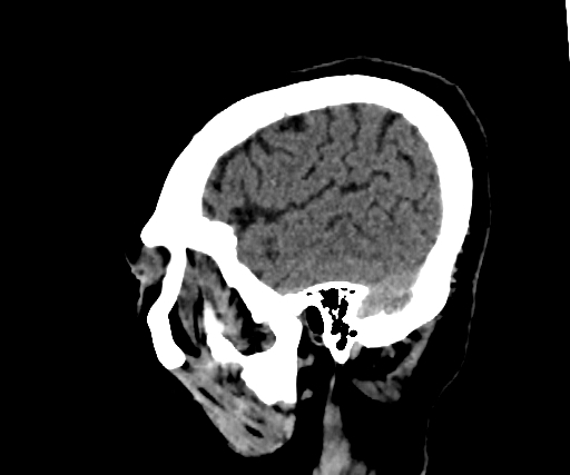 Cavernous hemangioma of the cerebellar falx (Radiopaedia 73025-83723 B 272).jpg