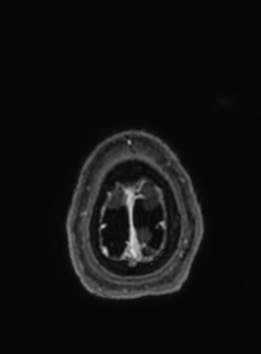 Cavernous hemangioma of the cerebellar falx (Radiopaedia 73025-83724 Axial T1 C+ 21).jpg