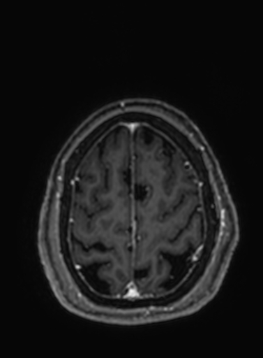 Cavernous hemangioma of the cerebellar falx (Radiopaedia 73025-83724 Axial T1 C+ 60).jpg