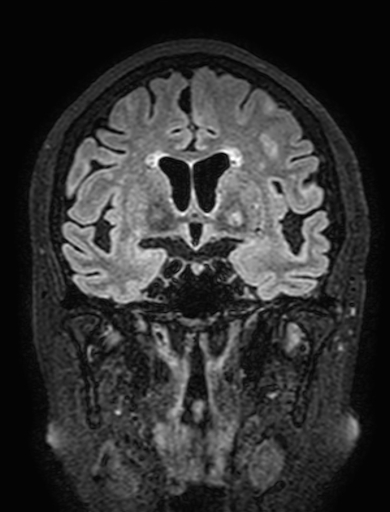 Cavernous hemangioma of the cerebellar falx (Radiopaedia 73025-83724 Coronal FLAIR 144).jpg
