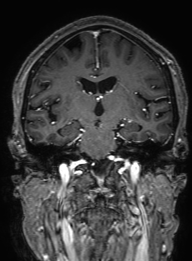 Cavernous hemangioma of the cerebellar falx (Radiopaedia 73025-83724 Coronal T1 C+ 197).jpg
