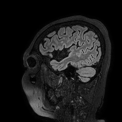 Cavernous hemangioma of the cerebellar falx (Radiopaedia 73025-83724 Sagittal FLAIR 32).jpg