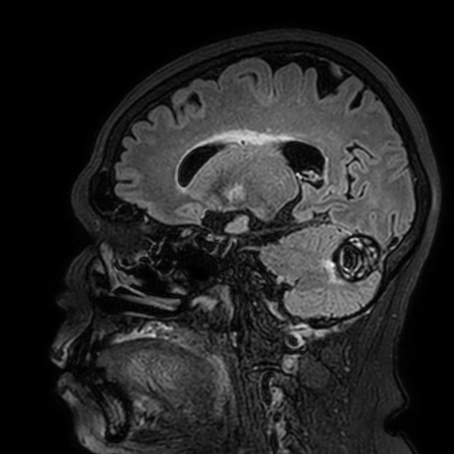 Cavernous hemangioma of the cerebellar falx (Radiopaedia 73025-83724 Sagittal FLAIR 80).jpg